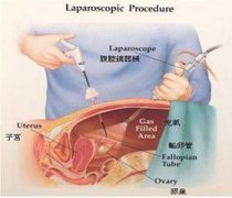 关于腹腔镜手术处理输卵管积水的四问四答