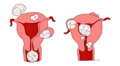 患子宫肌瘤可以做试管婴儿吗？
