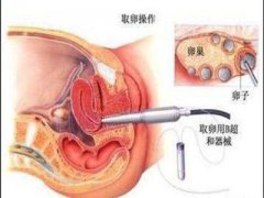 试管婴儿取卵后月经失调该怎么办？