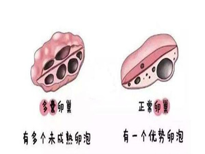 多囊卵巢综合症有哪些改善方式